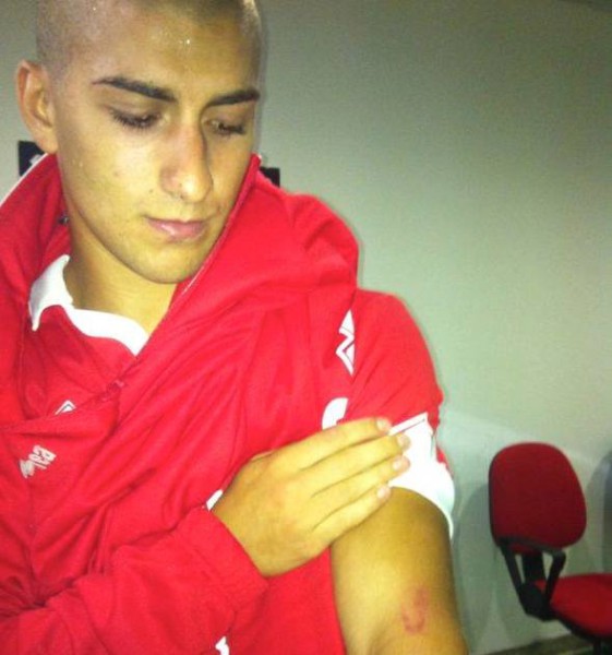 De Luca mostra a mordida que levou de Comi (Foto: divulga&ccedil;&atilde;o)