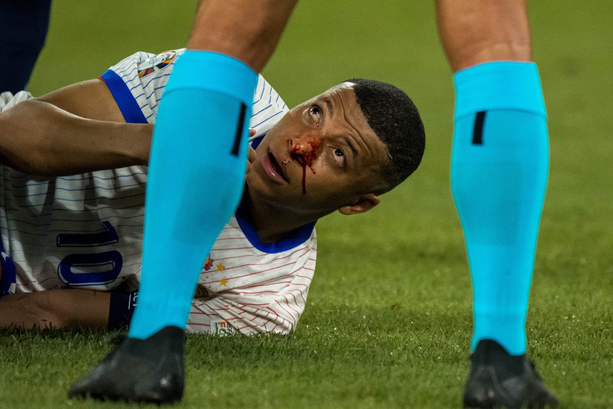 Mbapp&eacute; fratura o nariz e Federa&ccedil;&atilde;o Francesa anuncia decis&atilde;o sobre o jogador